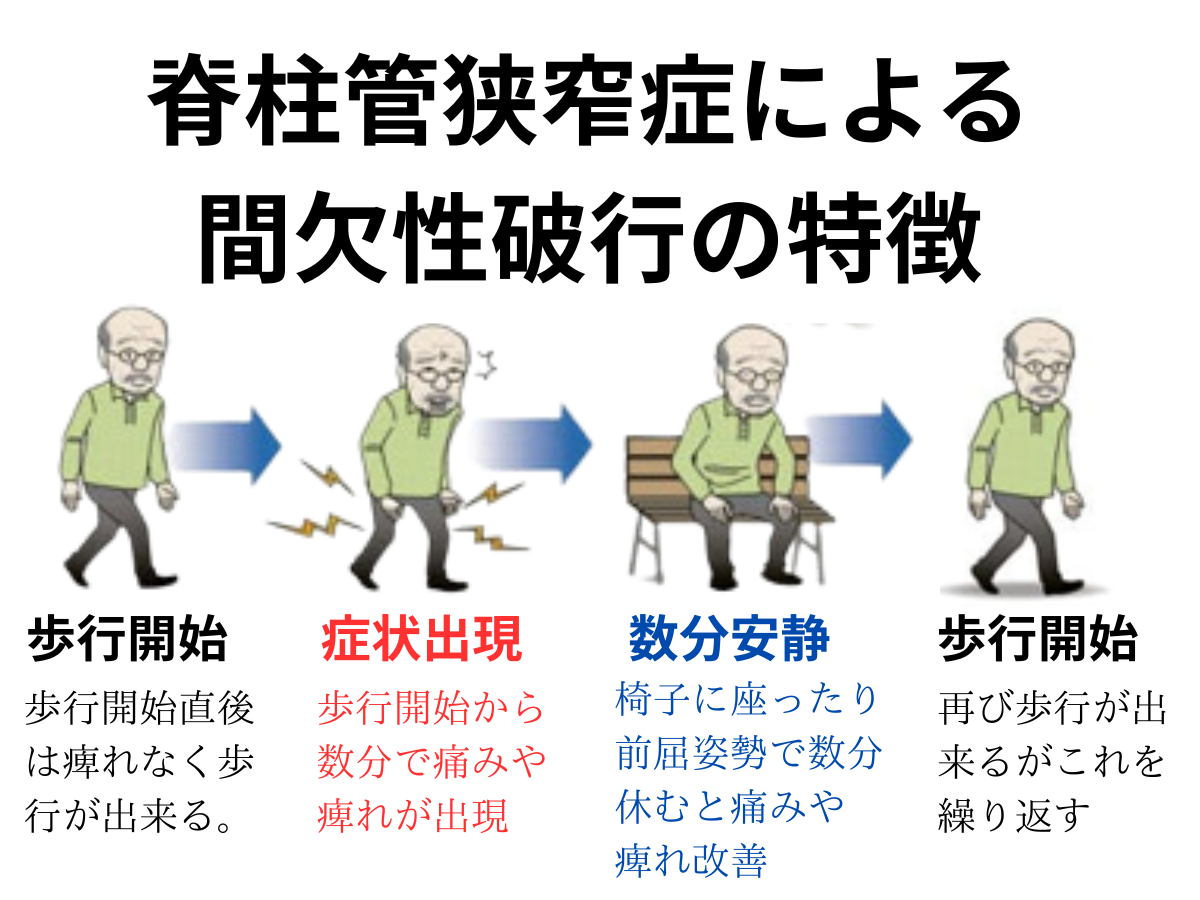 脊柱管狭窄症の症状について